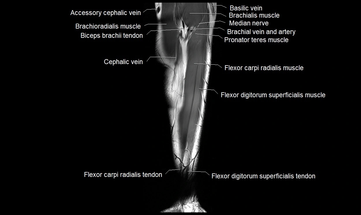 MRI 3T forearm coronal cross sectional anatomy image 5.webp